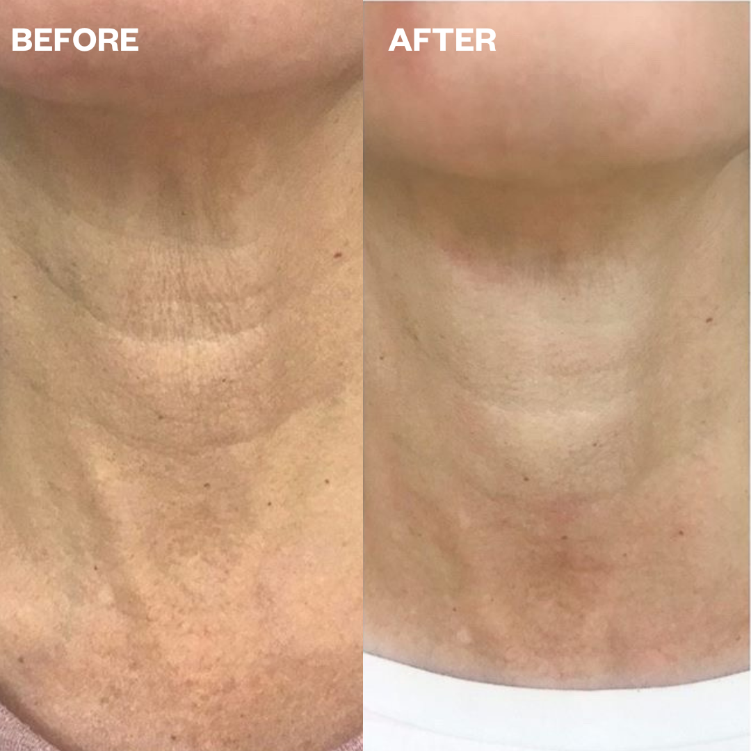 Wrinkles Schminkles blog banner, guide to treating neck lines and tech neck without procedures