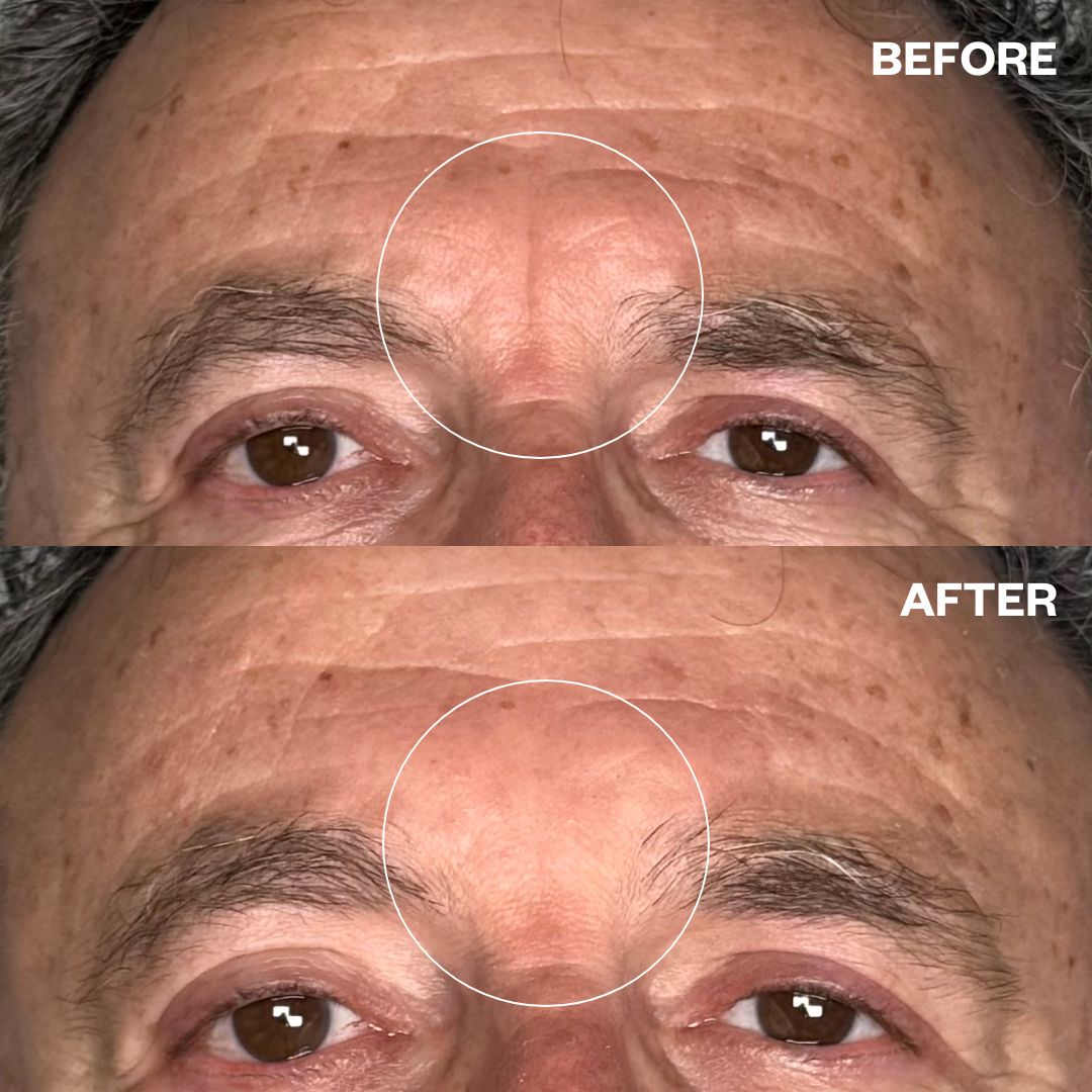 Before and after results using Men's Pro forehead wrinkle patches, side view