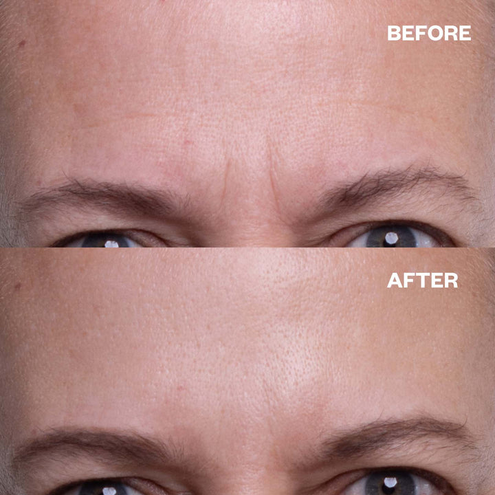 Forehead & Eye 'Notox' Bundle