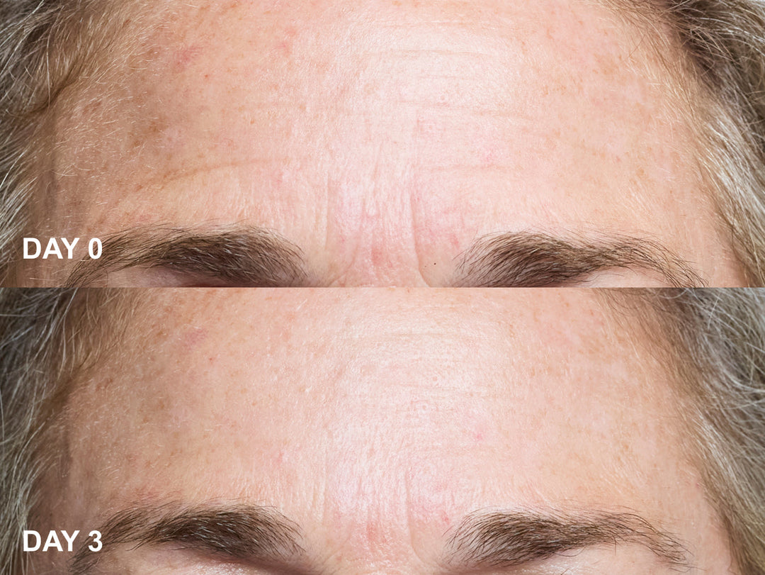 Wrinkles Schminkles forehead wrinkle patches for frown lines, blog banner