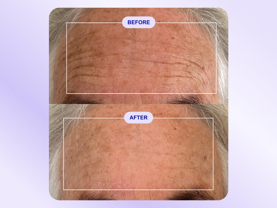 Wrinkles Schminkles blog banner featuring a customer's forehead wrinkle patch results