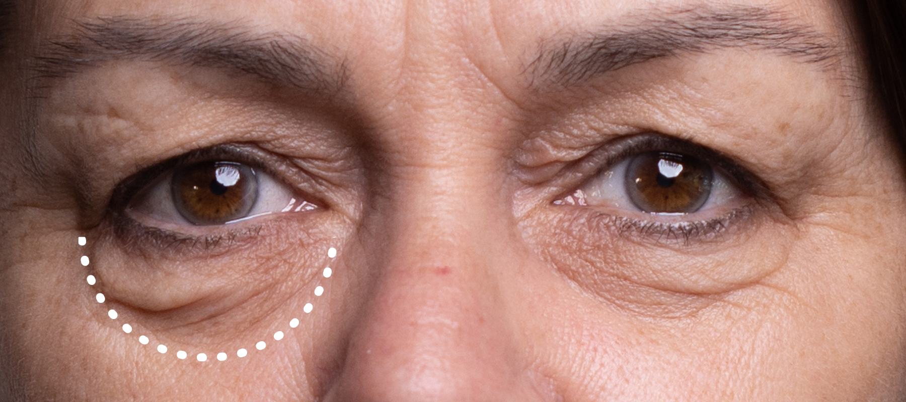Are You Considering Eye Bag Removal Surgery? <p> Find out about options the surgeons don't want you to know about!