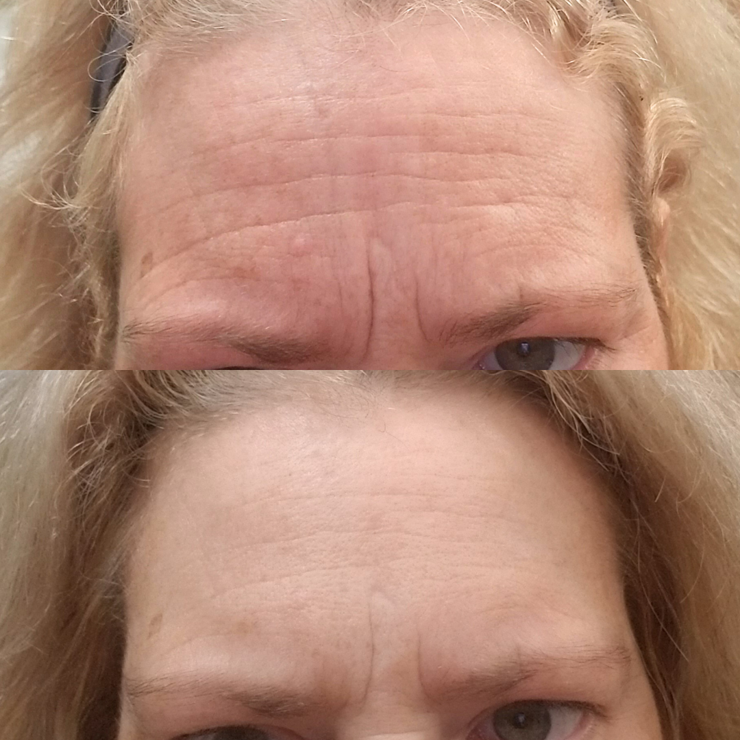 Wrinkles Schminkles blog banner on treating forehead wrinkles and frown lines without needles