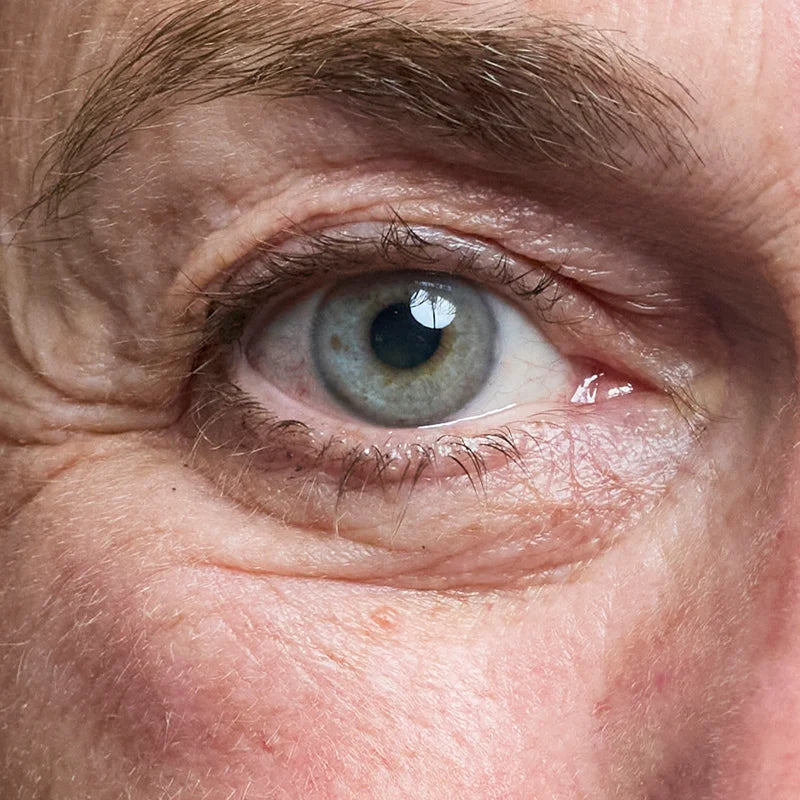 EYE_BEFORE.webp
