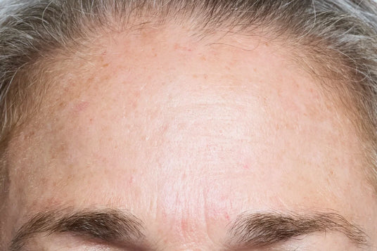 FOREHEAD_AFTER_2.webp
