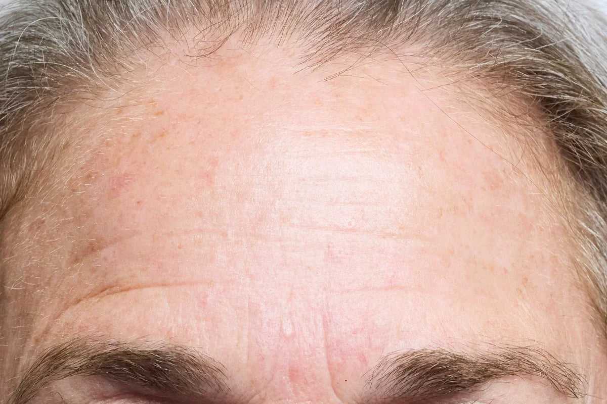 FOREHEAD_BEFORE_2.webp