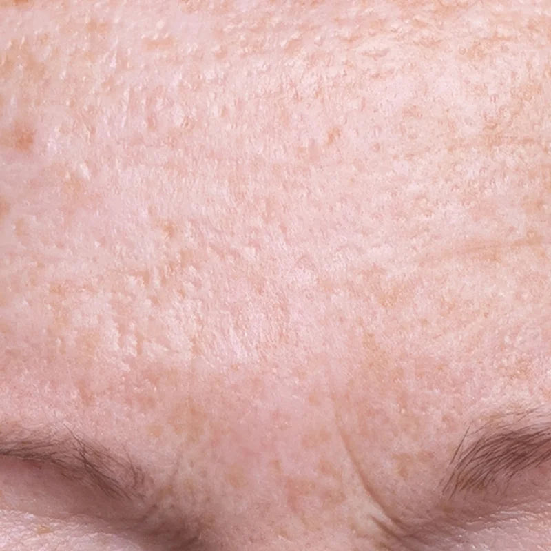 FORHEAD_AFTER.webp