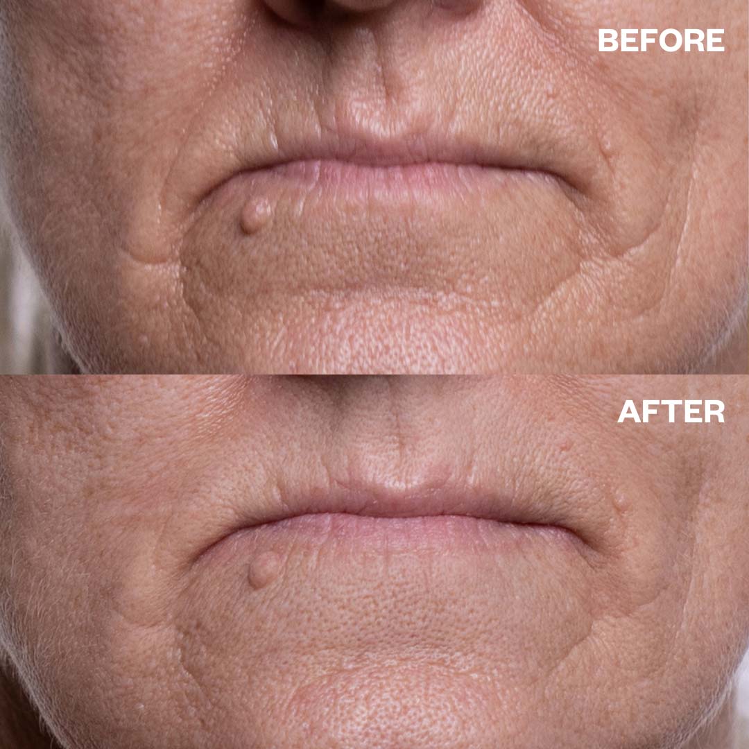 Before and after results using Jowl & Neck Lift Bundle for marionette lines and lip lines