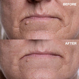 Before and after results using Jowl & Neck Lift Bundle for marionette lines and lip lines