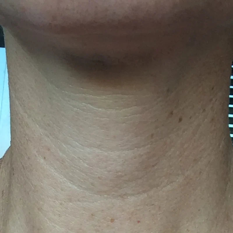 NECK_AFTER_1.webp