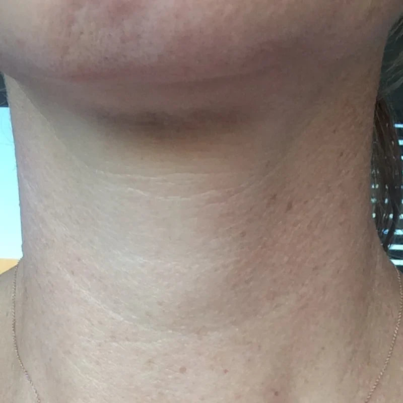 NECK_BEFORE_2e134b8a-9776-4bde-b115-e8f7fc3a2eae.webp