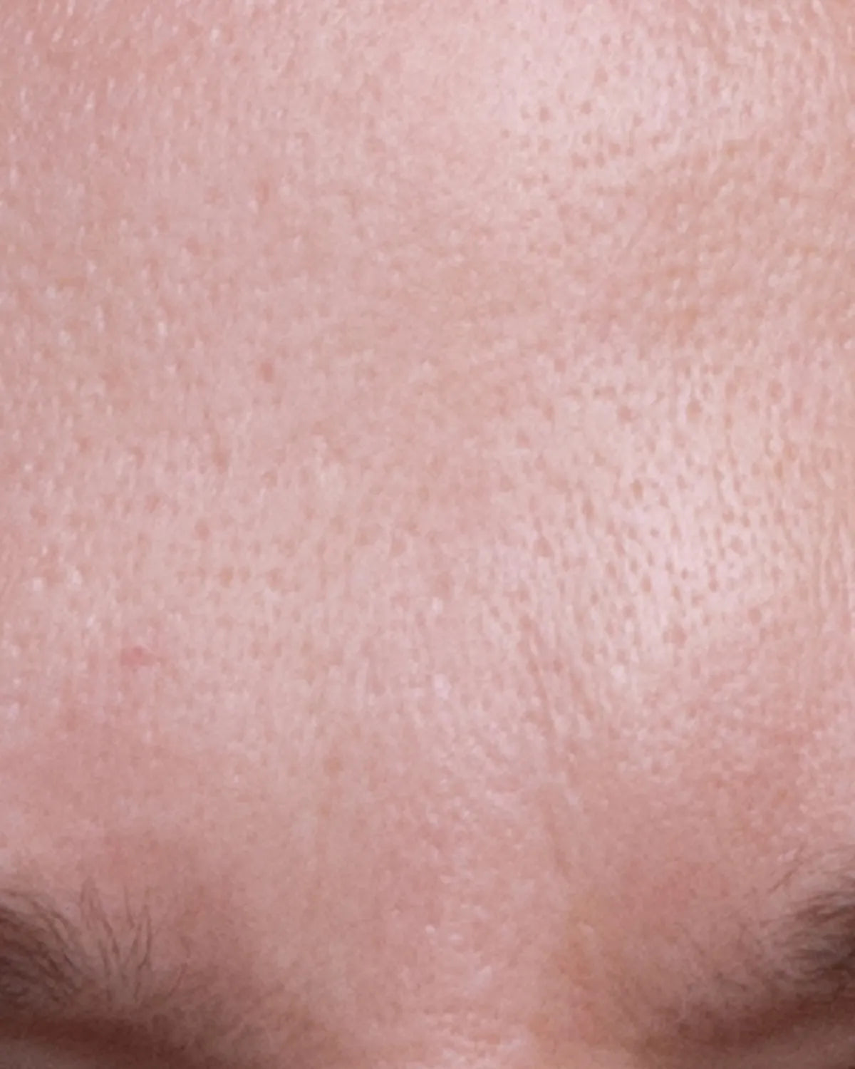 after-forehead-carousel.webp