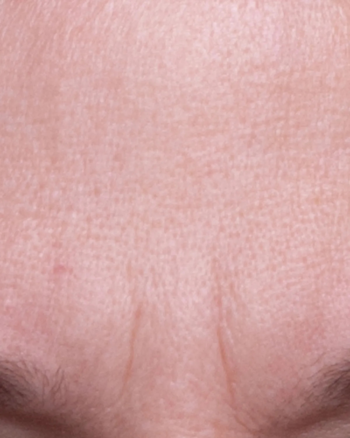 before-forehead-carousel.webp