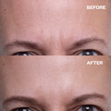 Before and after results using forehead wrinkle patches to smooth forehead lines