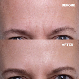 Before and after results using forehead wrinkle patches to smooth forehead lines