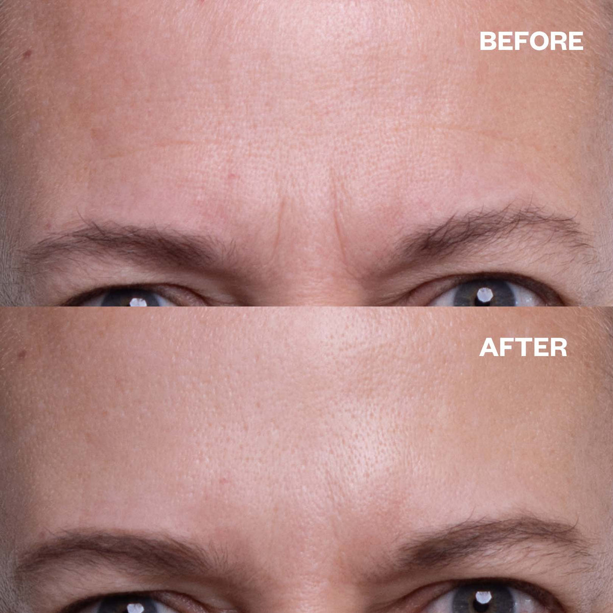 Before and after results using Deep Forehead Wrinkles Duo for forehead lines