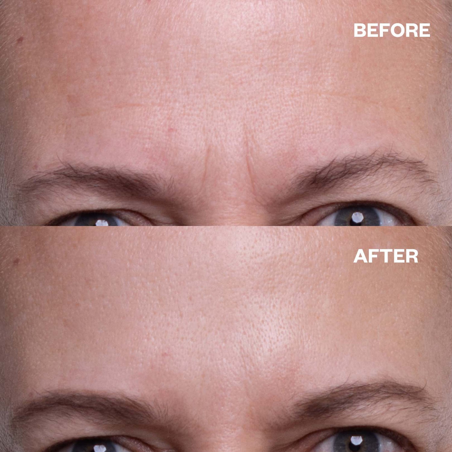 NEW - Brow Frown & Bunny Lines Wrinkle Patch | Trial Patch