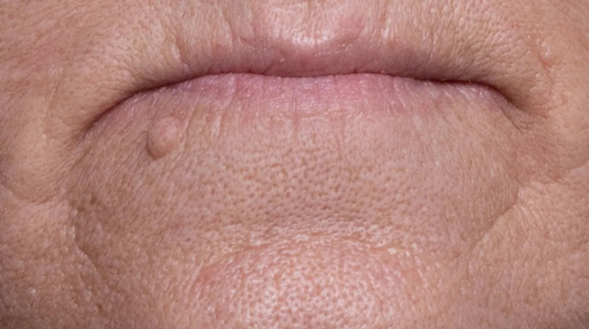 mouth-after.webp