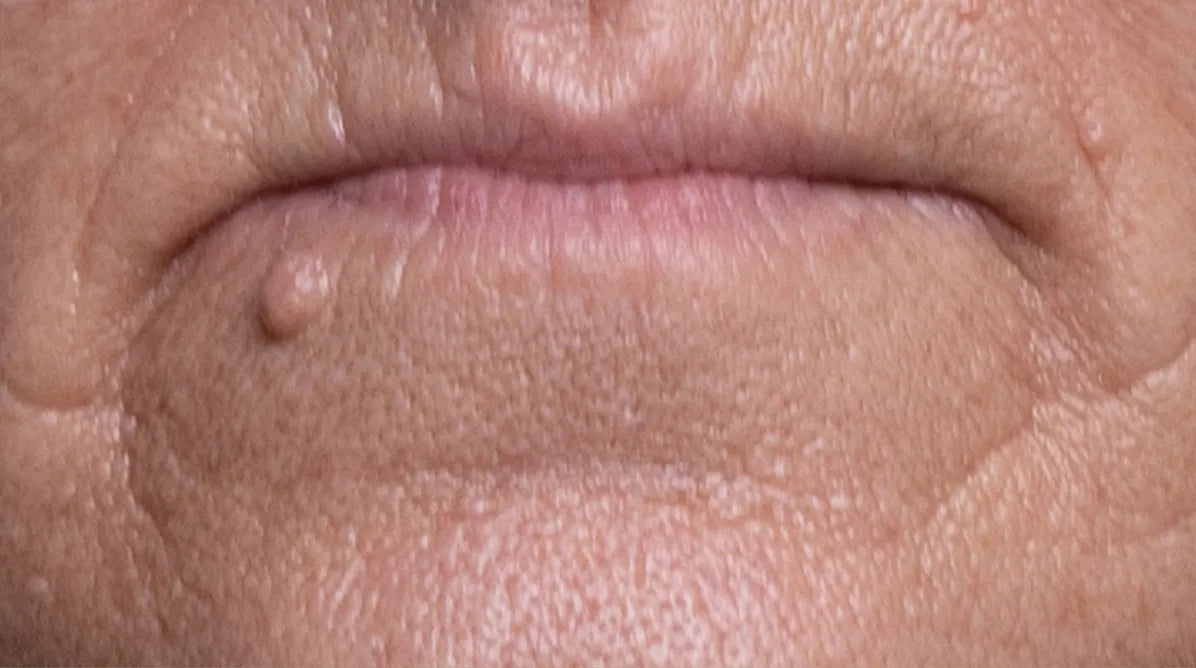 mouth-before.webp